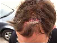 manual post-pounder injury